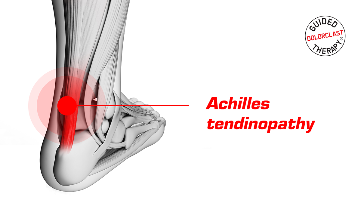 achilles tendinopathy