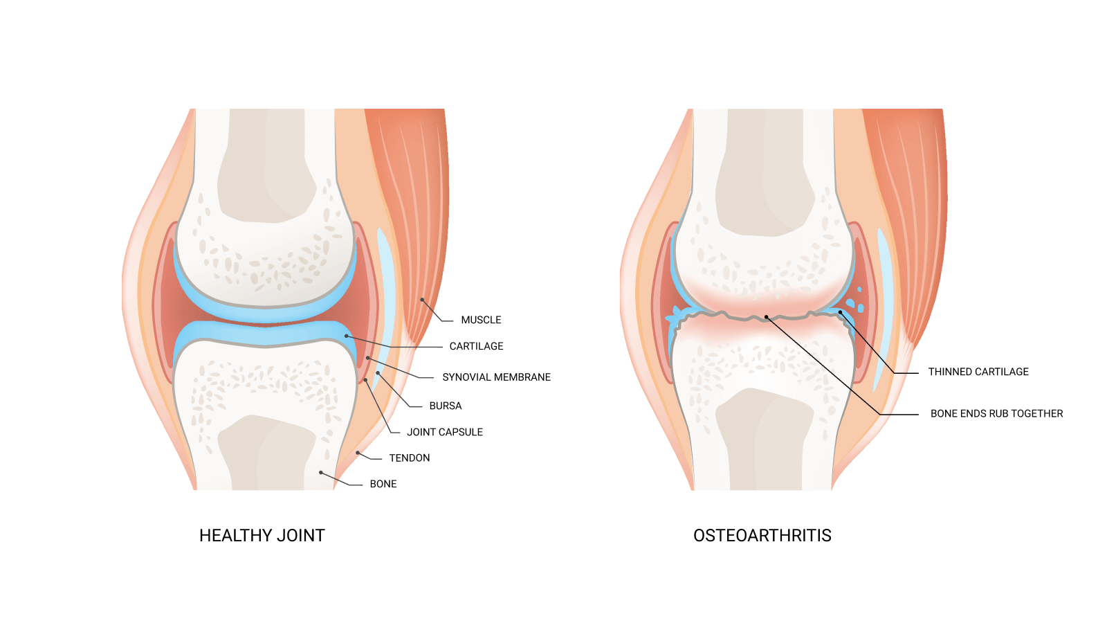 image of healthy joint vs. osteoarthritis