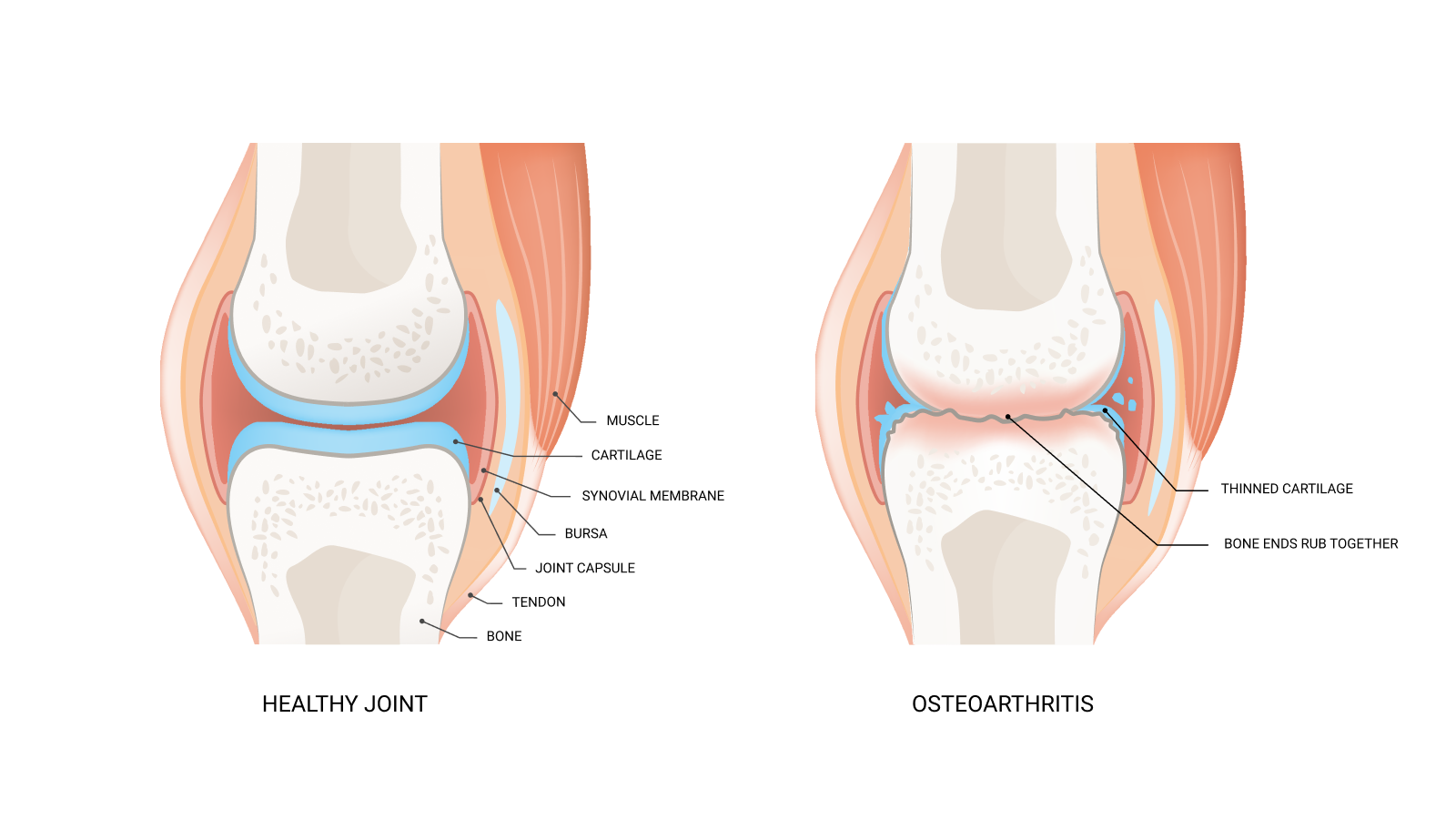 comparison between an healthy joint and a joint with osteoarthritis