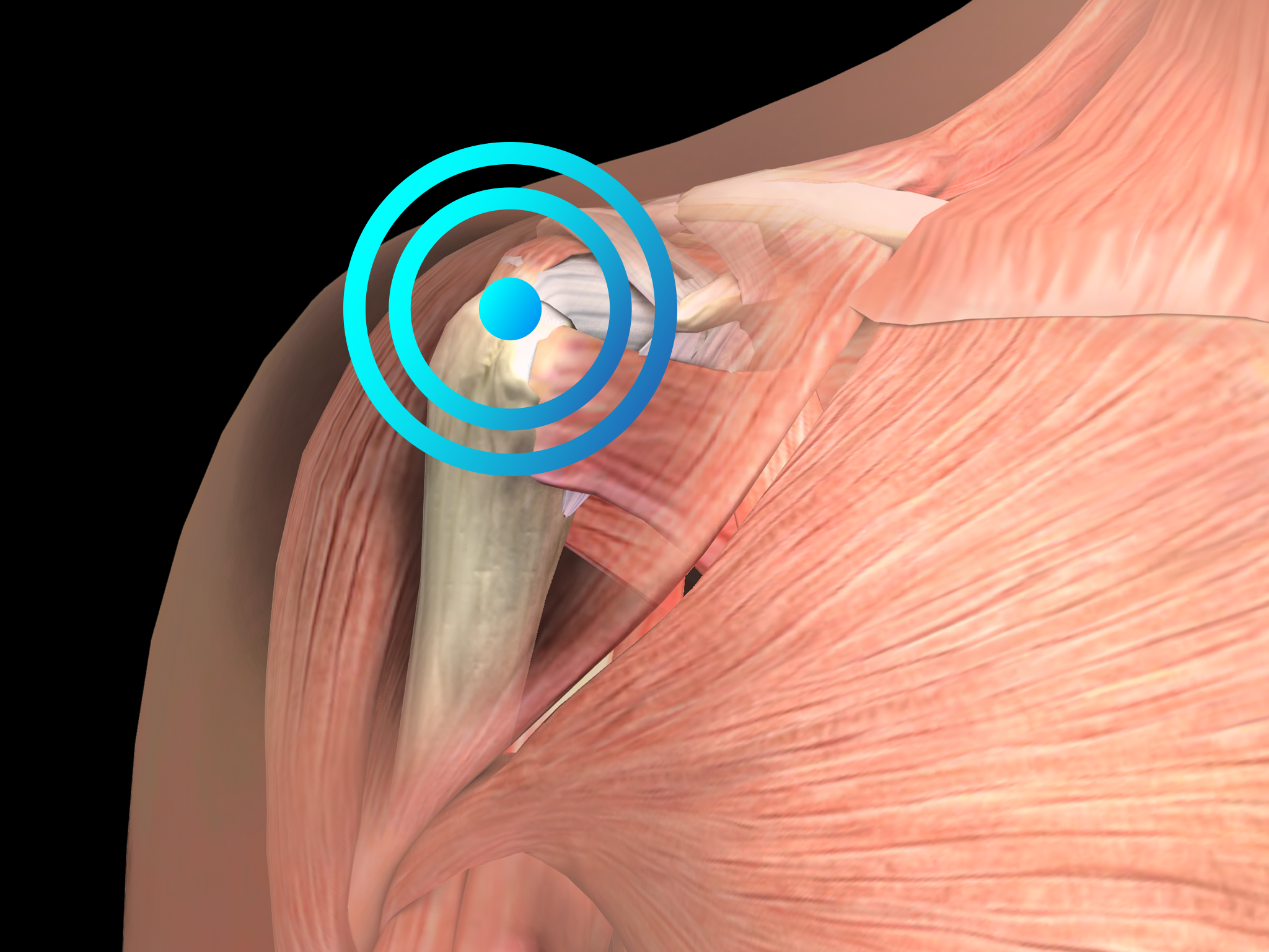 Calcifying tendinitis of the shoulder