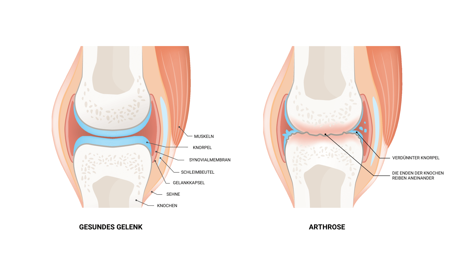 image of healthy joint vs. osteoarthritis