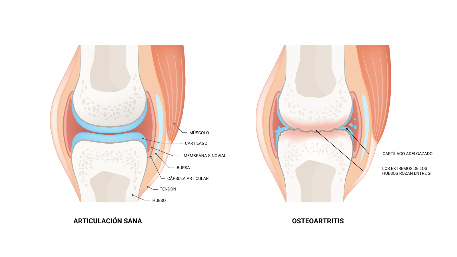 comparison between an healthy joint and a joint with osteoarthritis