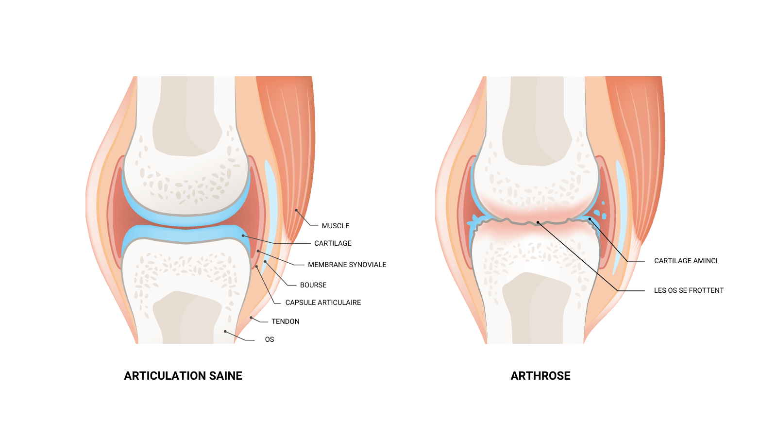 comparison between an healthy joint and a joint with osteoarthritis