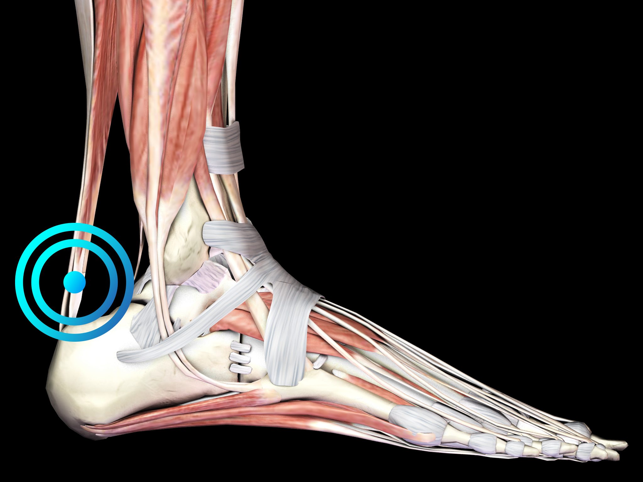 Insertional achilles tendinopathy