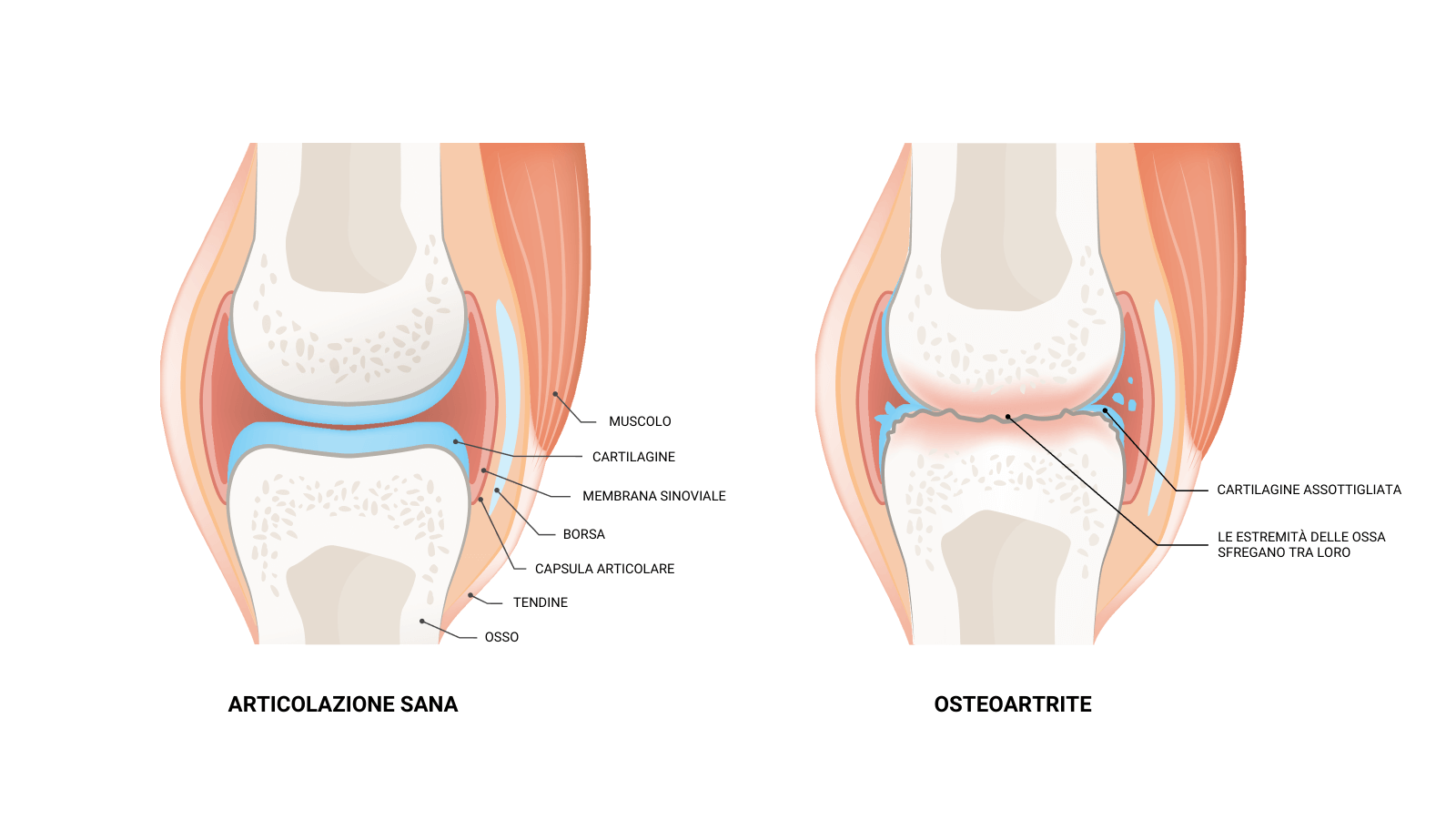 image of healthy joint vs. osteoarthritis