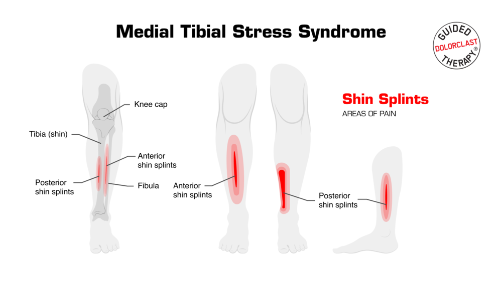 medial tibial stress syndrome illustration