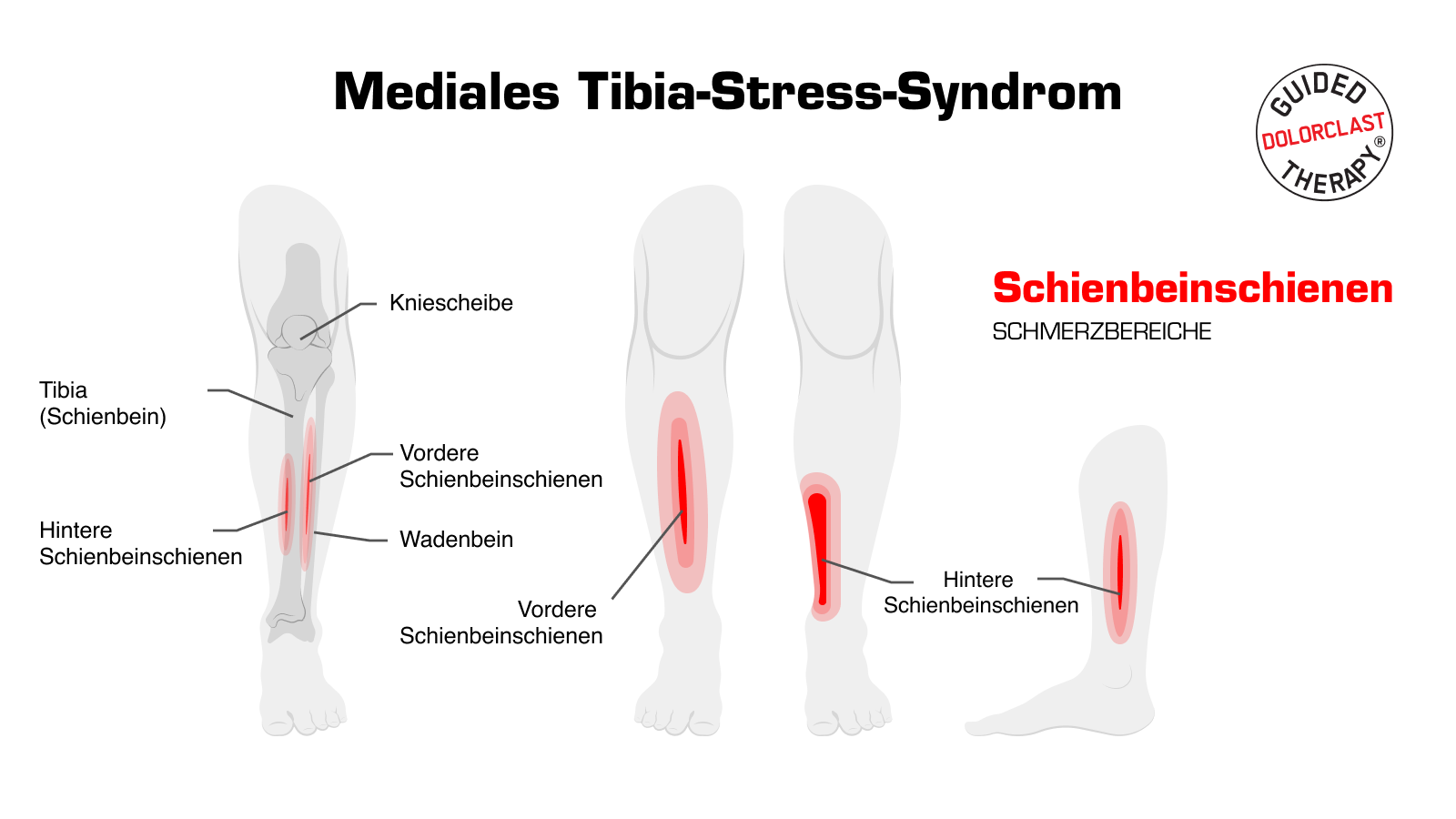 Mediales tibia-stress-syndrom