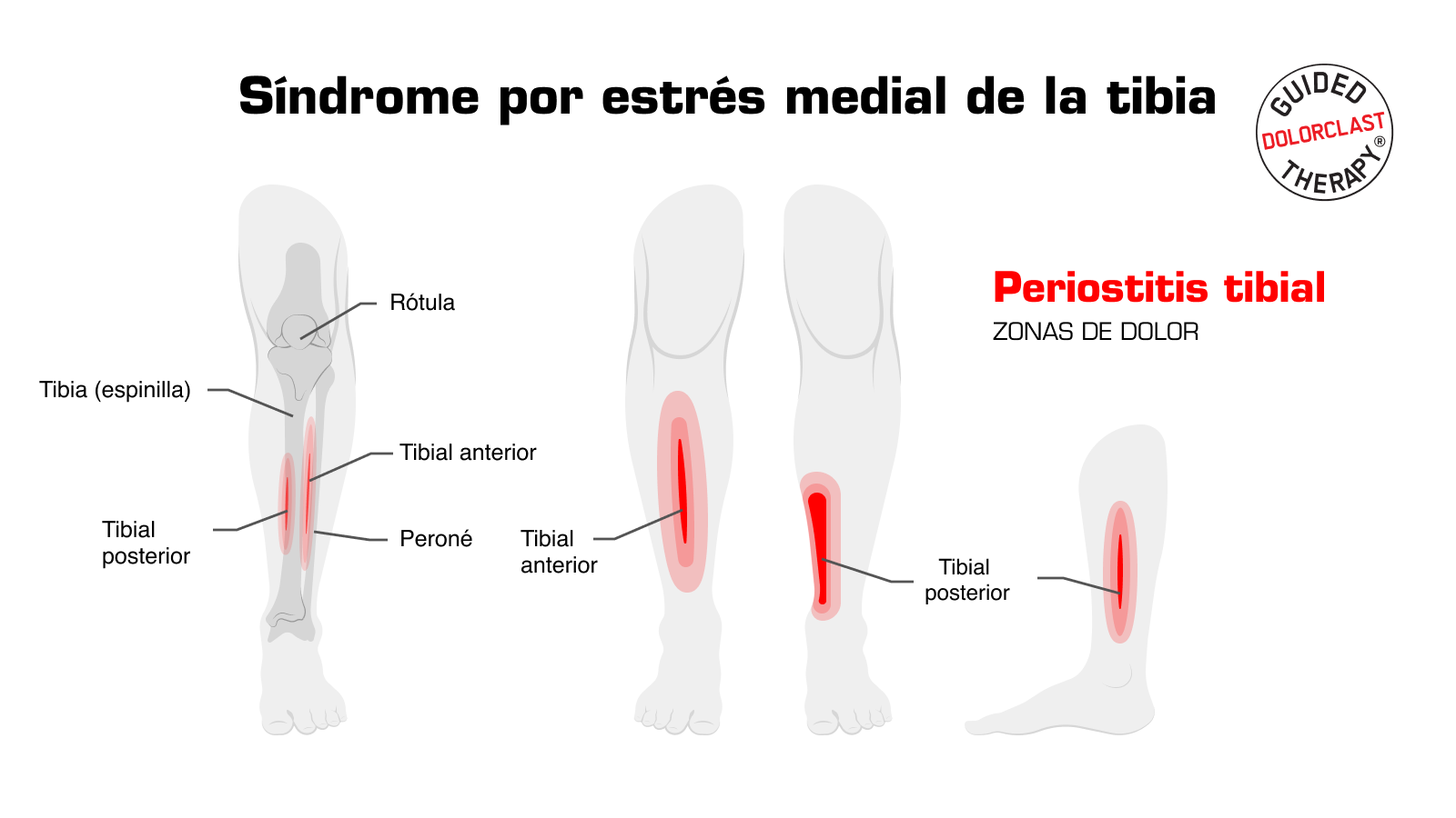 Síndrome por estrés medial de la tibia