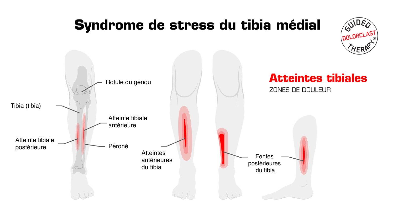 visualisation syndrome de stress du tibia médial