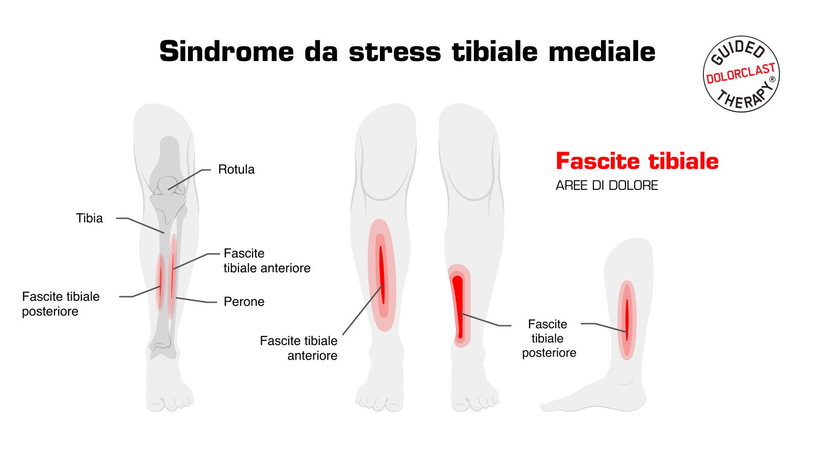Sindrome da stress tibiale mediale