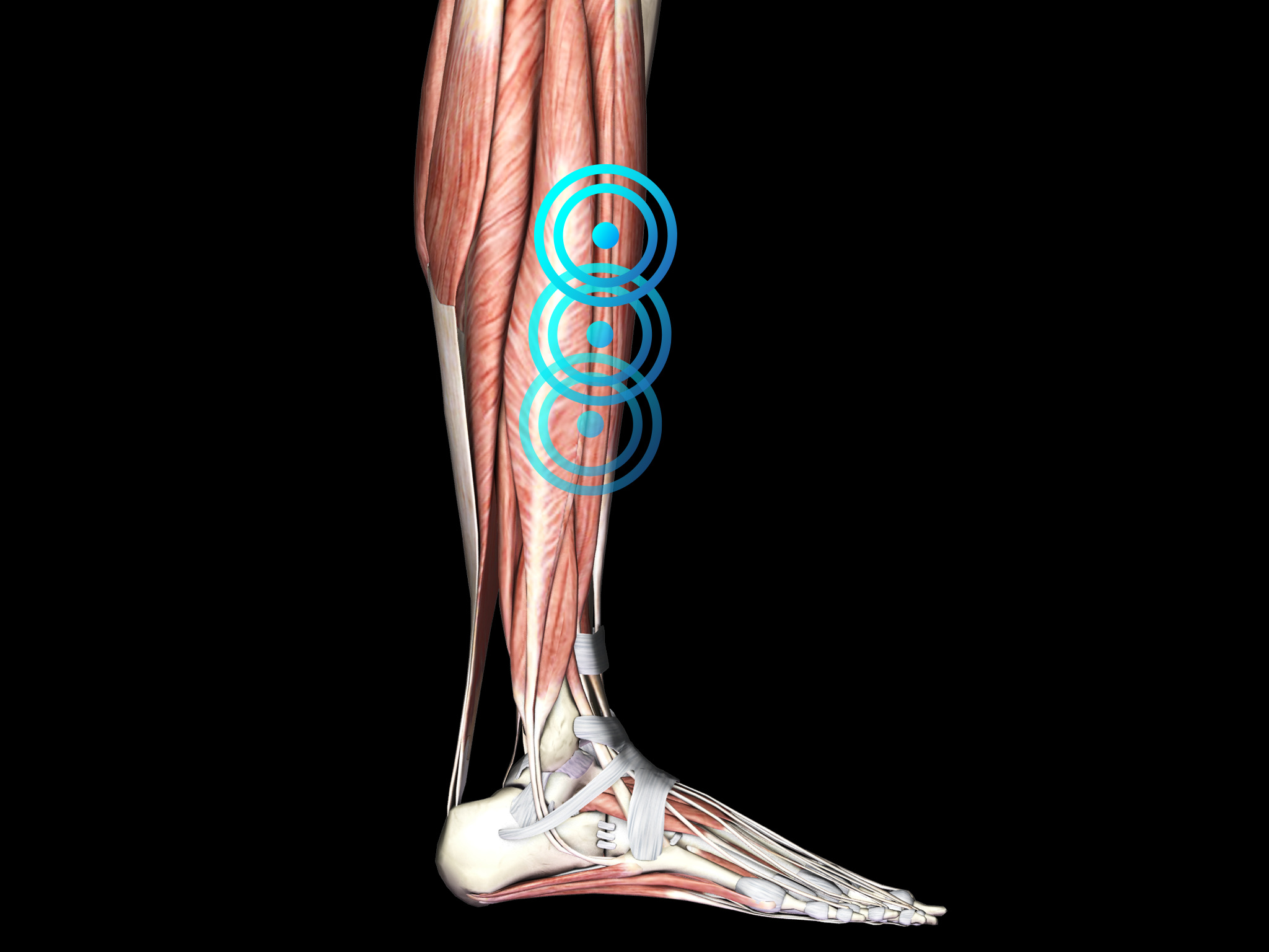 Périostite tibiale | EMS Pain Therapy