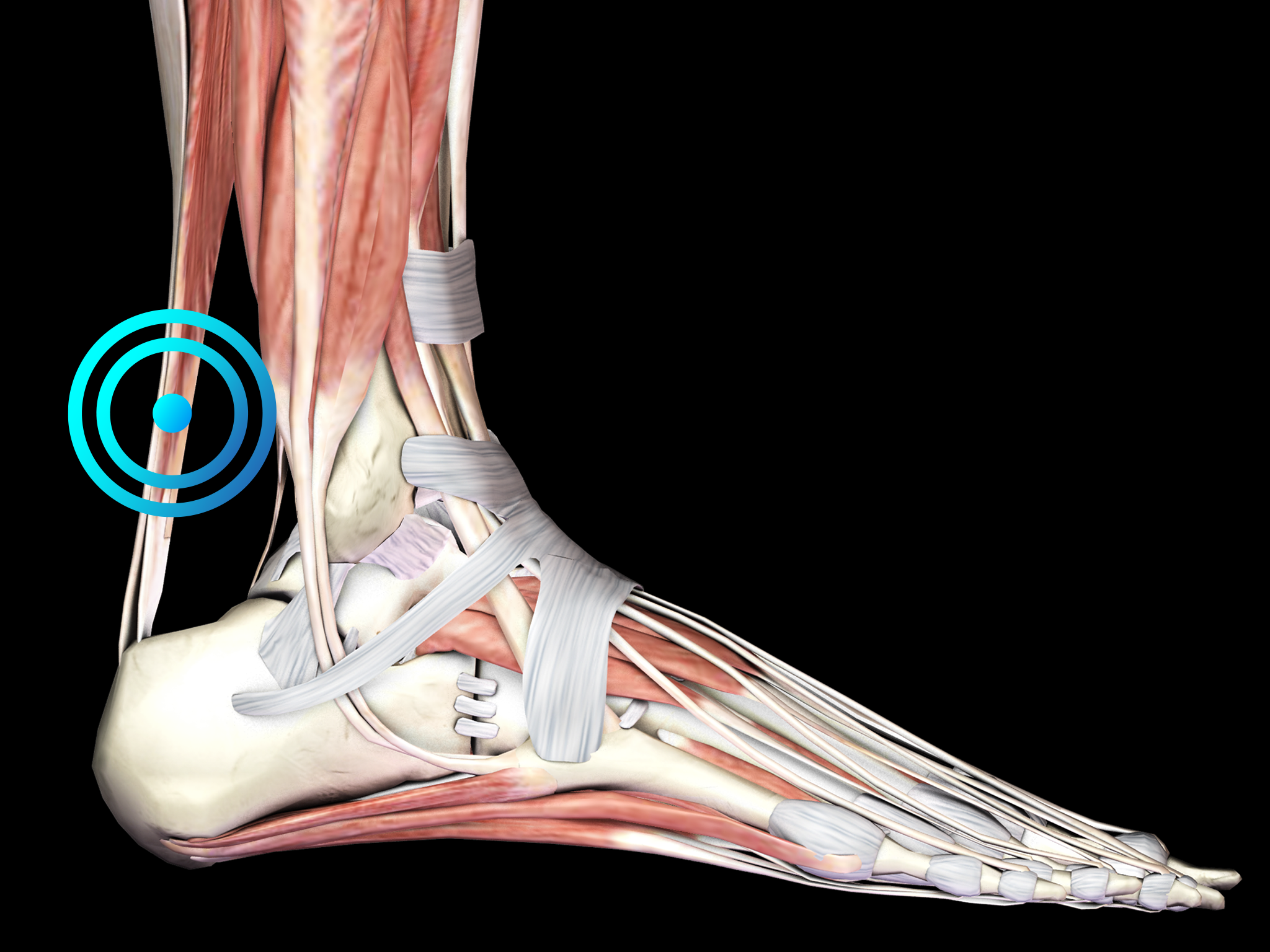 Midbody achilles tendinopathy