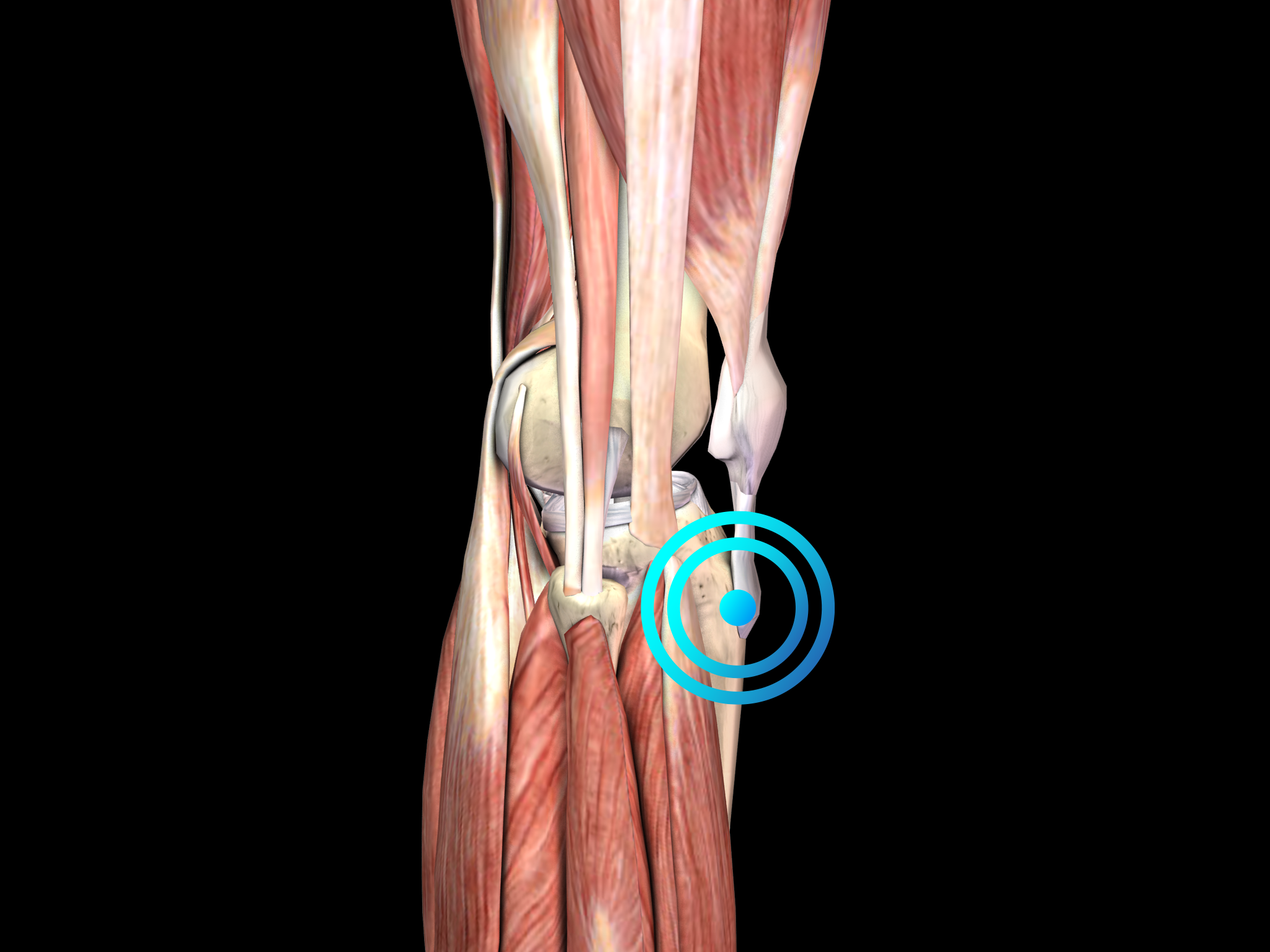 Osgood-Schlatter disease