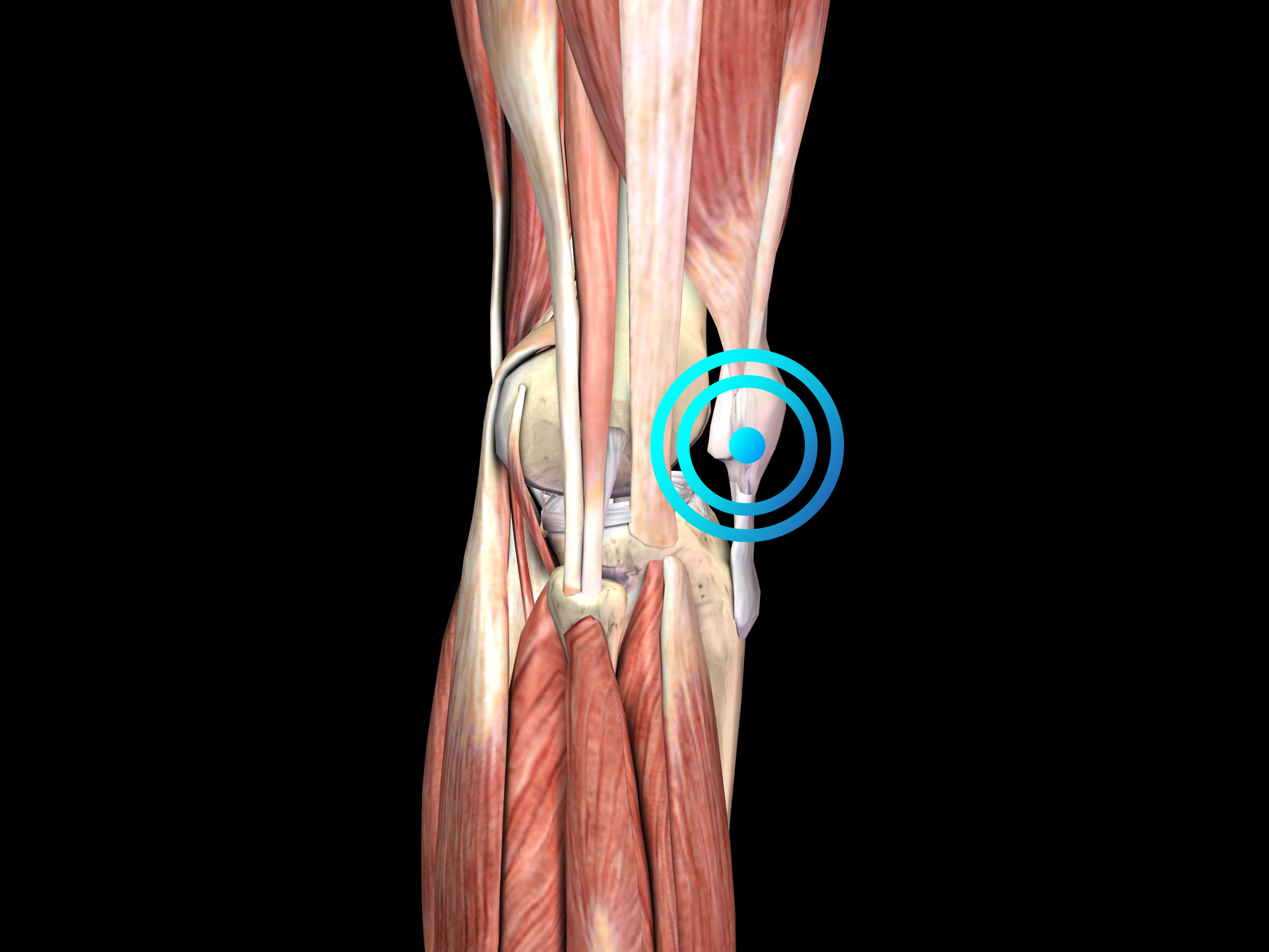 Tendinopathie rotulienne | EMS Pain Therapy