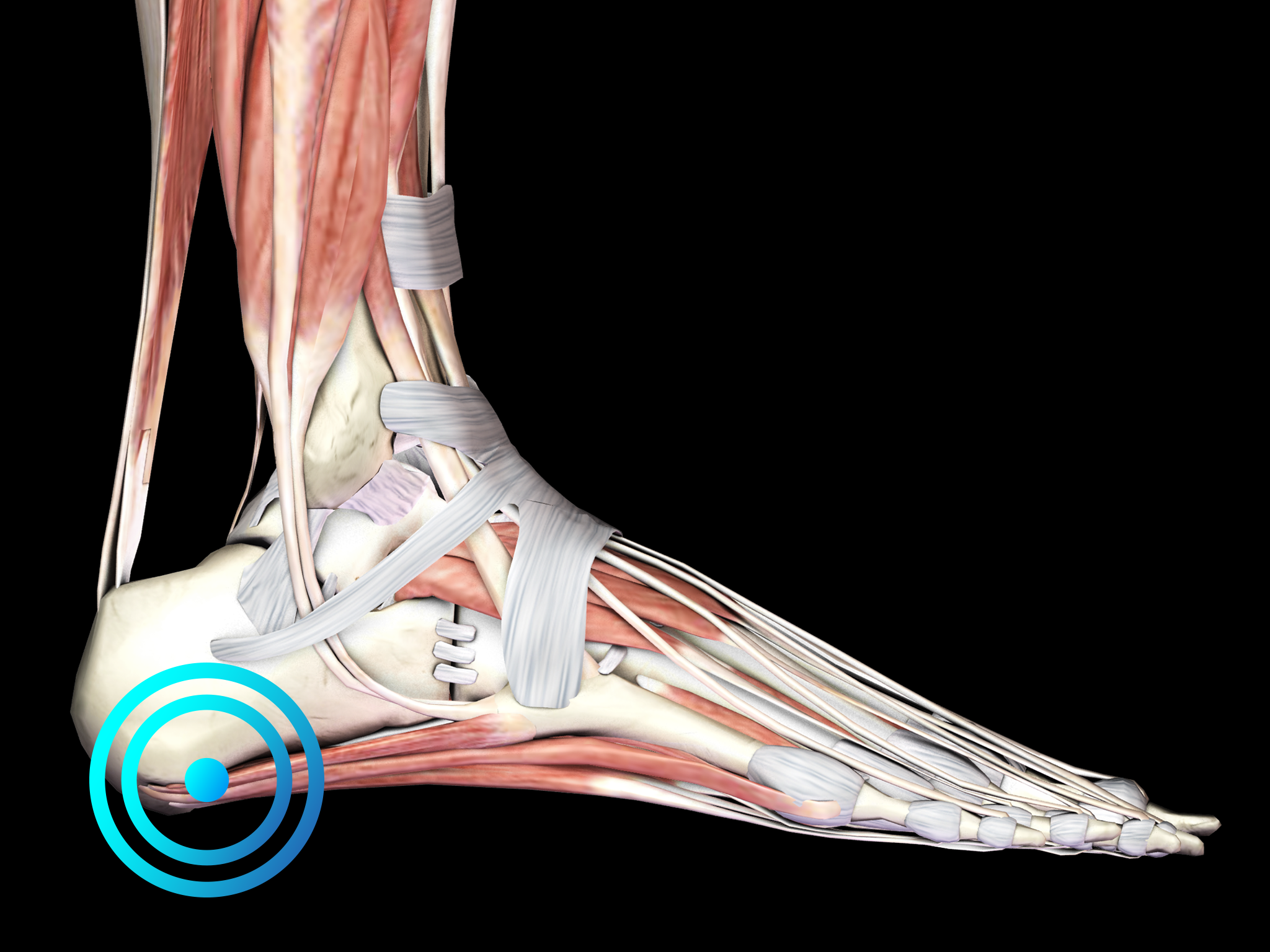 Plantar fasciopathy