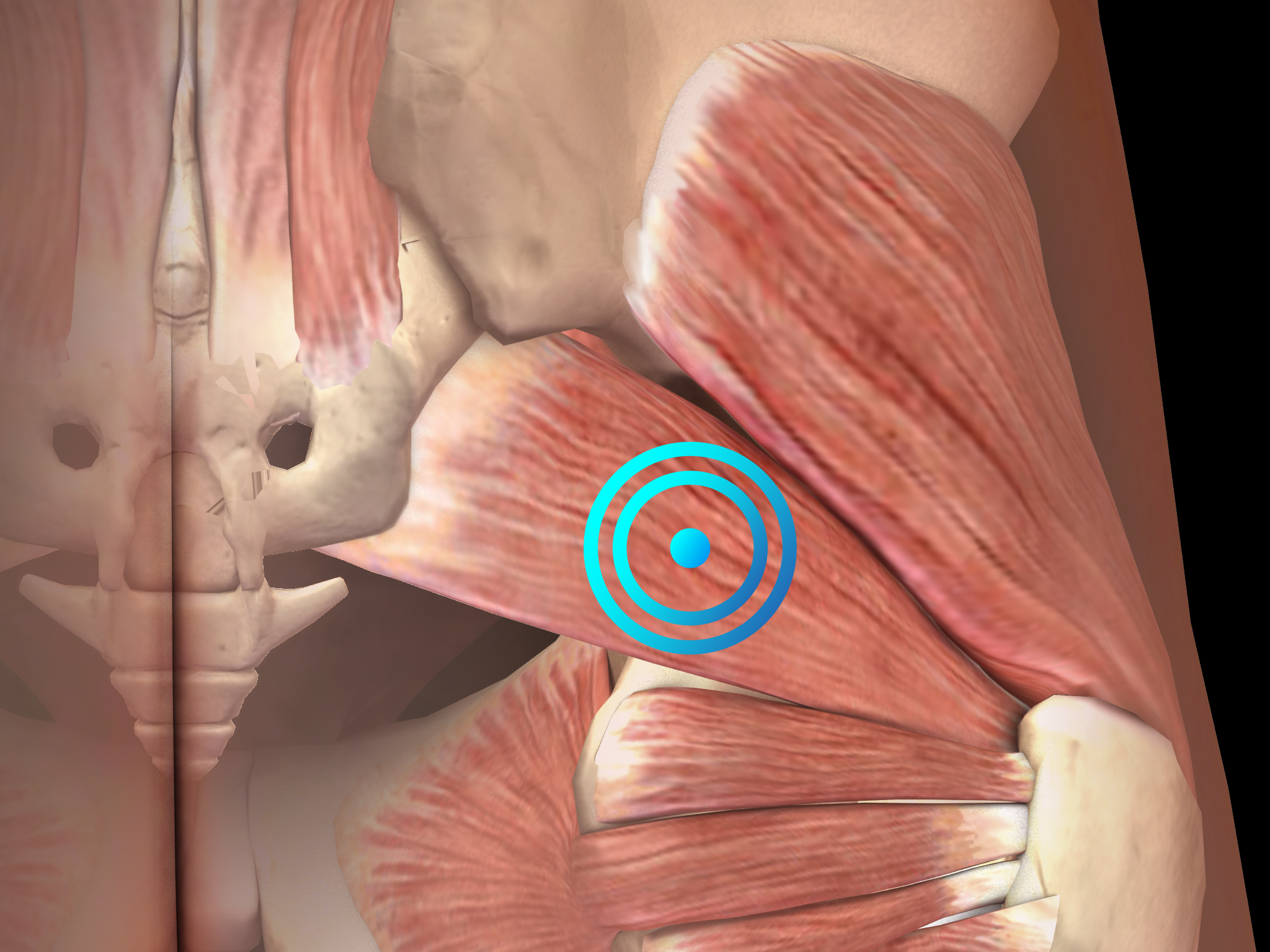 Pseudoradicular Low Back Pain