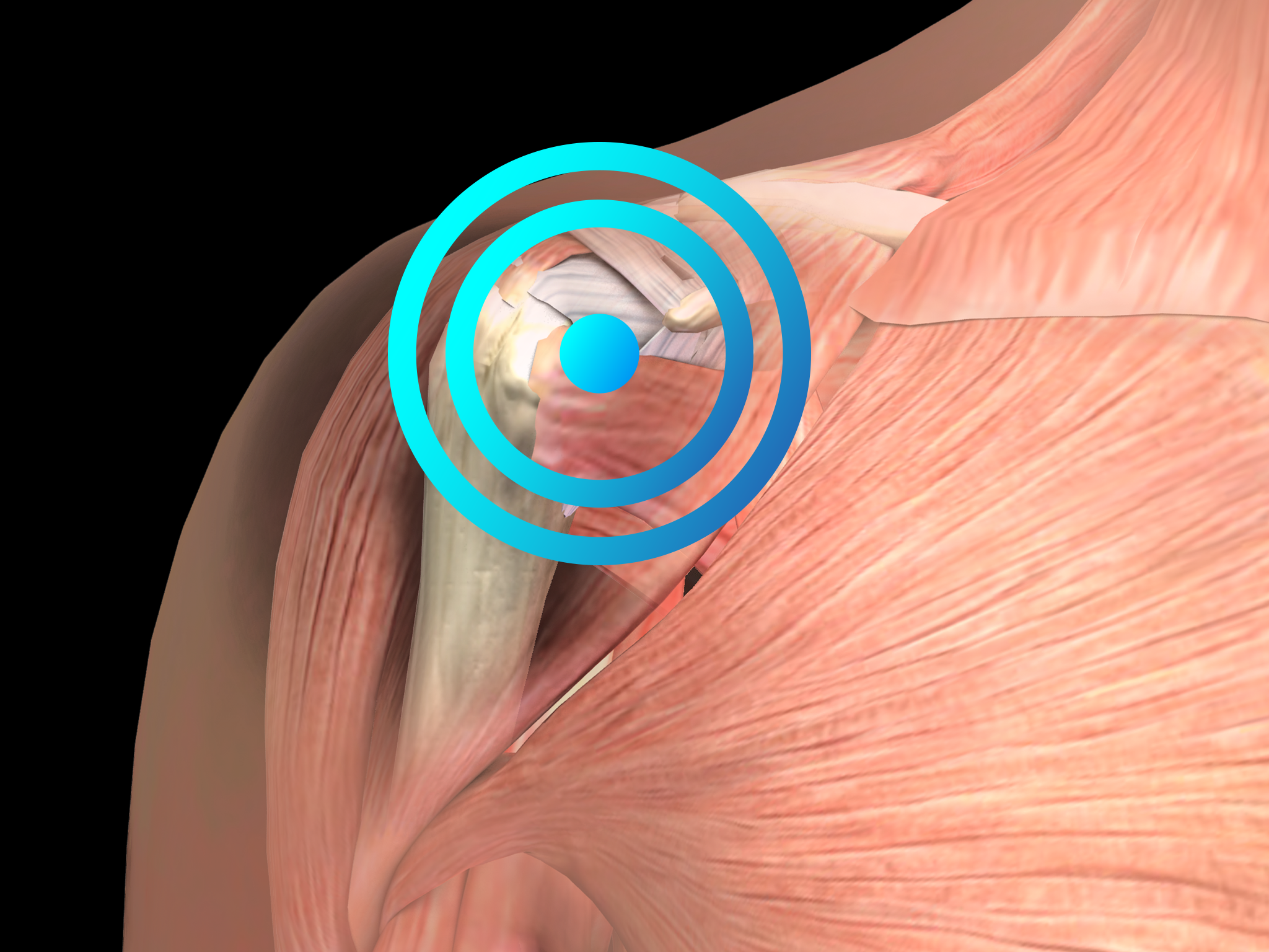 Subacromial shoulder pain