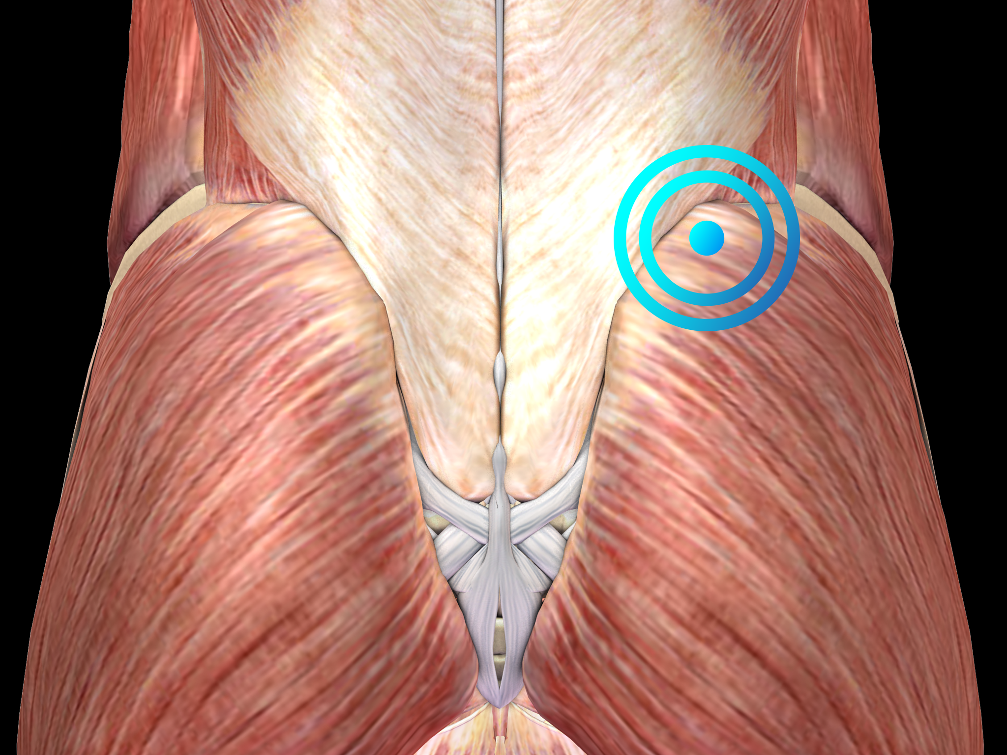 Trigger Points