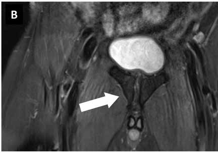 Ver Que Es Edema De La Medula Osea más Ver Que Es Edema De La Medula Osea más