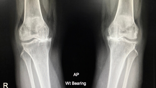 osteoarthritis x ray